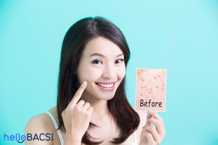 Kháng sinh trị mụn gồm những loại nào? Khi nào nên sử dụng?