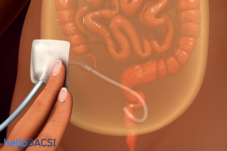 Lọc màng bụng (thẩm phân phúc mạc)