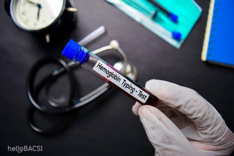 4 cách phân độ thiếu máu mà bạn cần biết