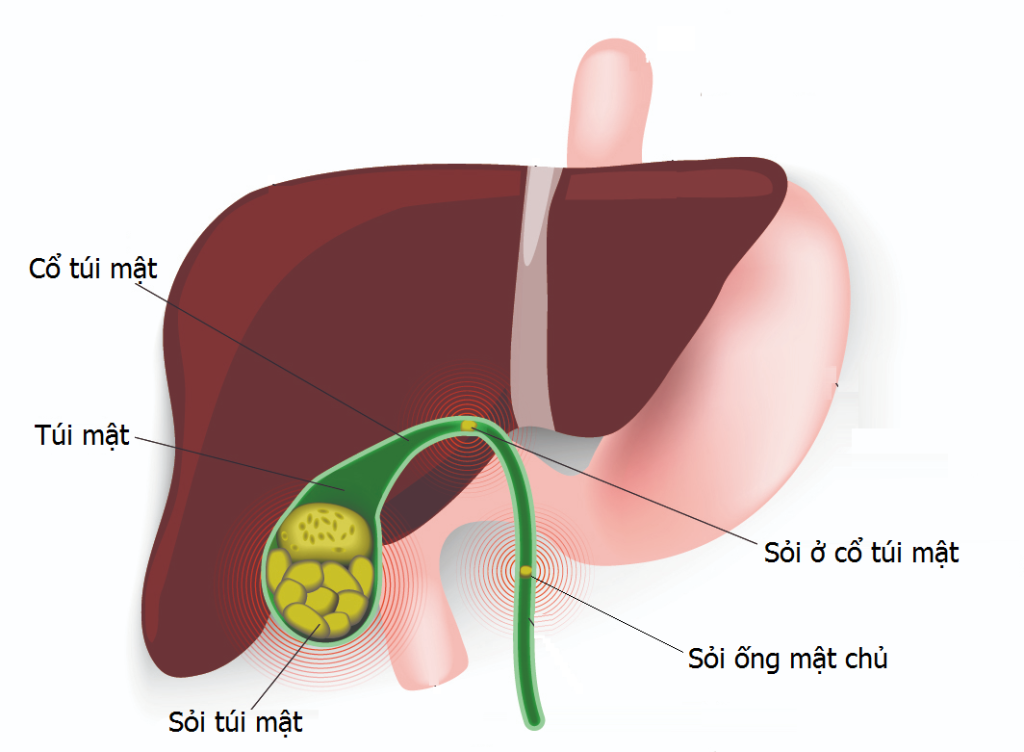 Vị trí sỏi túi mật