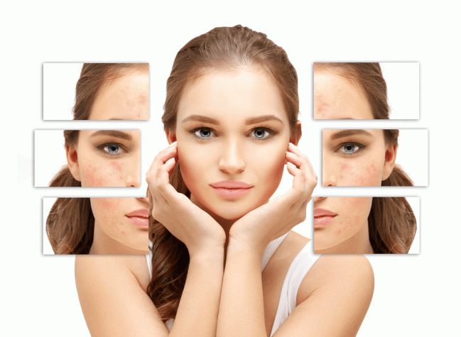 Cách trị sẹo mụn đơn giản và hiệu quả tại nhà