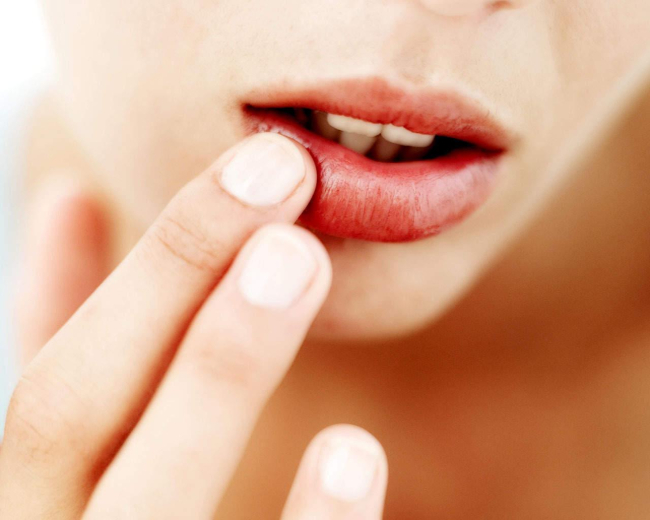 Bệnh ở môi - Kẻ thù hàng đầu của sắc đẹp