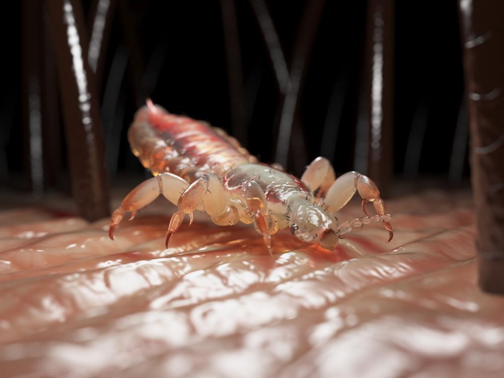 Chấy rận (chí rận) và những điều cần biết và cách phòng tránh