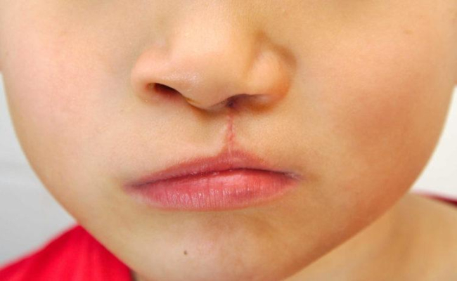 Sứt môi hở hàm ếch có di truyền không? Cách điều trị dứt điểm