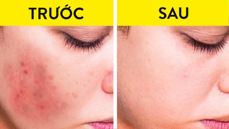 Đánh bay mụn sưng đỏ siêu nhanh với 5 mẹo đơn giản sau