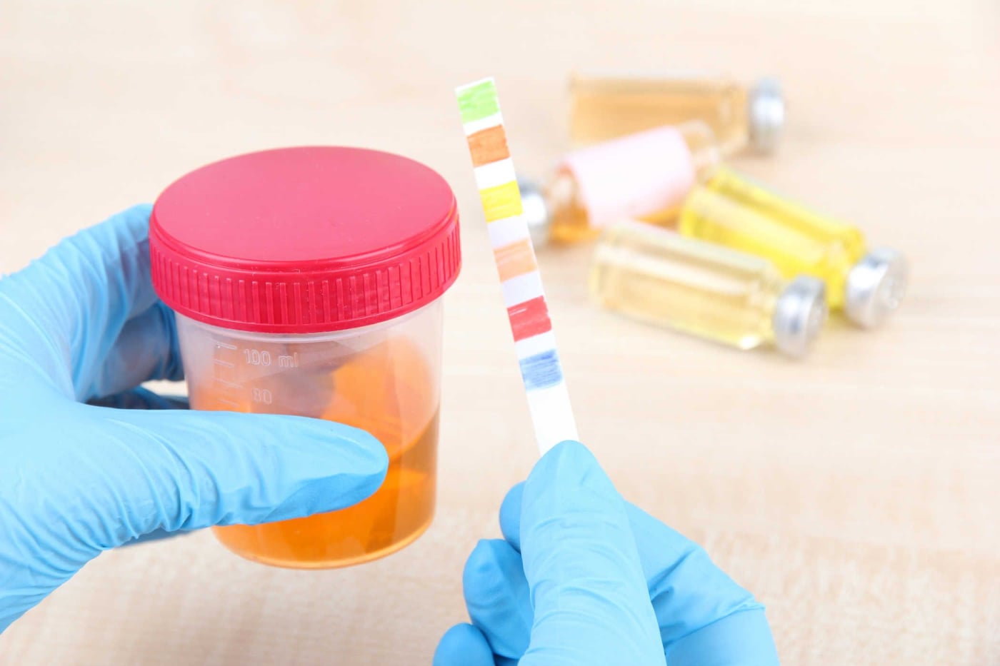 Xét nghiệm nước tiểu trong bệnh tiểu đường