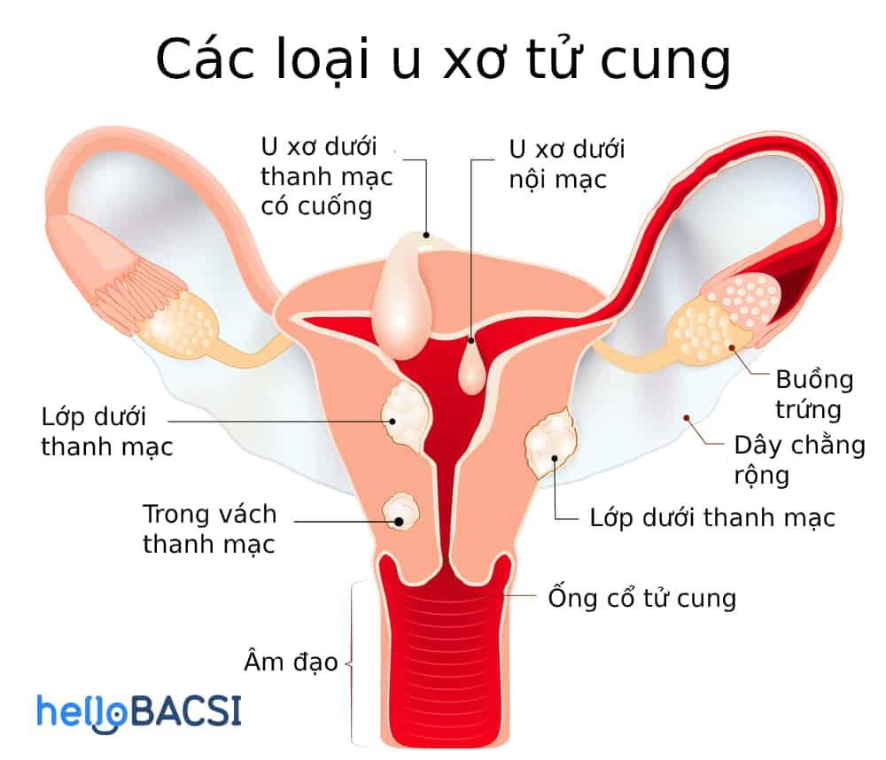 Nhân xơ tử cung có nguy hiểm không và mọi điều cần biết