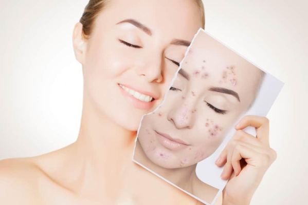 Tretinoin là thuốc gì? Công dụng & liều dùng Hello Bacsi
