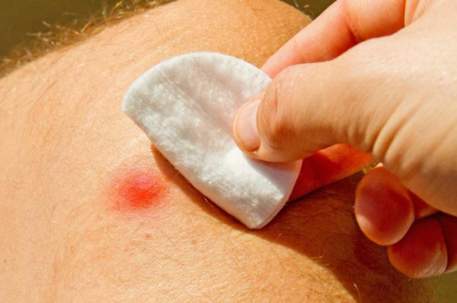 Giúp bạn nhận biết và xử trí phản ứng dị ứng