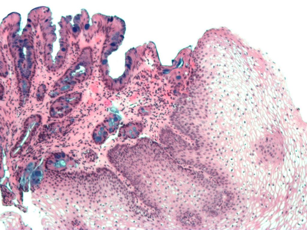Barrett thực quản