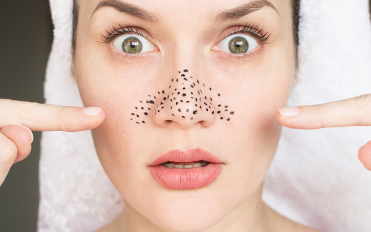 Mụn đầu đen là một dạng của mụn trứng cá