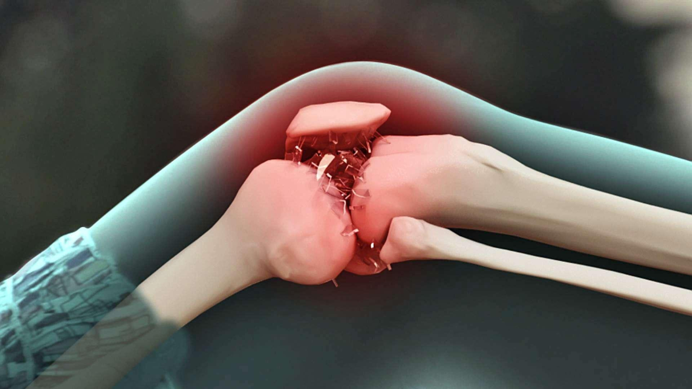 Bệnh viêm xương khớp: Những thông tin bạn cần biết