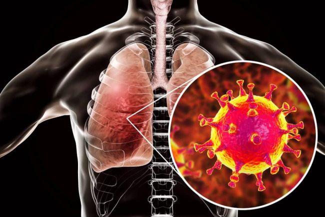 MERS (Hội chứng hô hấp Trung Đông)