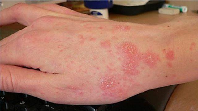 Bệnh ghẻ là gì? Cách trị thế nào cho nhanh khỏi?