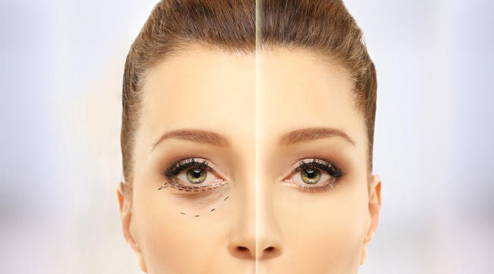 Khám phá 7 bài tập cho mắt sụp mí đơn giản, hiệu quả