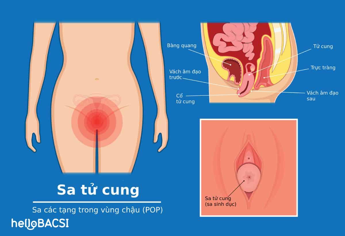 Sa tử cung (Sa sinh dục) là gì? Làm thế nào để nhận biết và chữa trị