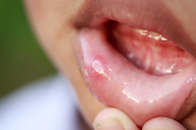 Oral Aid® Gel