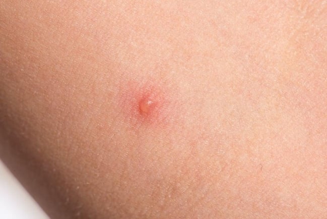 Mụn nước : Nguyên nhân và cách điều trị hiệu quả tại nhà