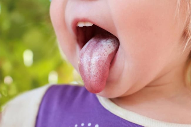 Nhiễm nấm Candida miệng là do đâu, điều trị và phòng ngừa thế nào?