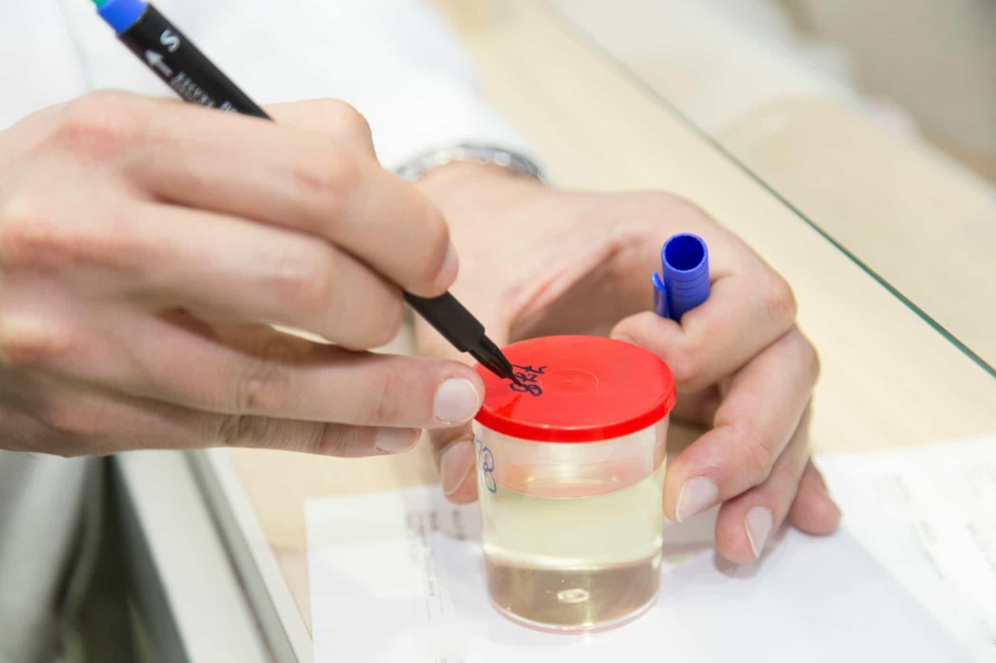 Xét nghiệm glucose nước tiểu