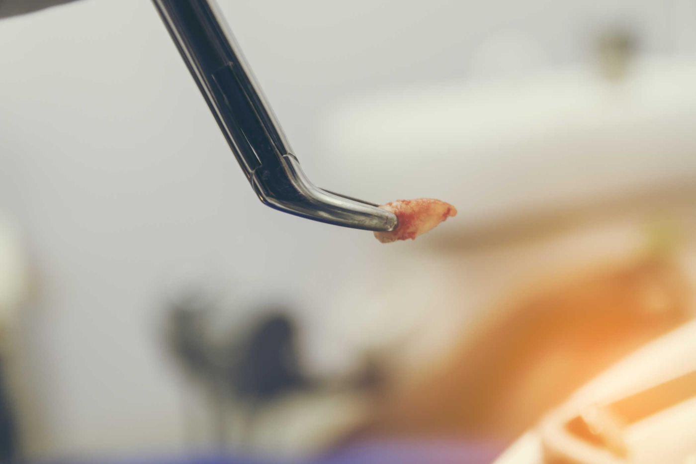 Những điều cần làm trước và sau khi nhổ răng khôn