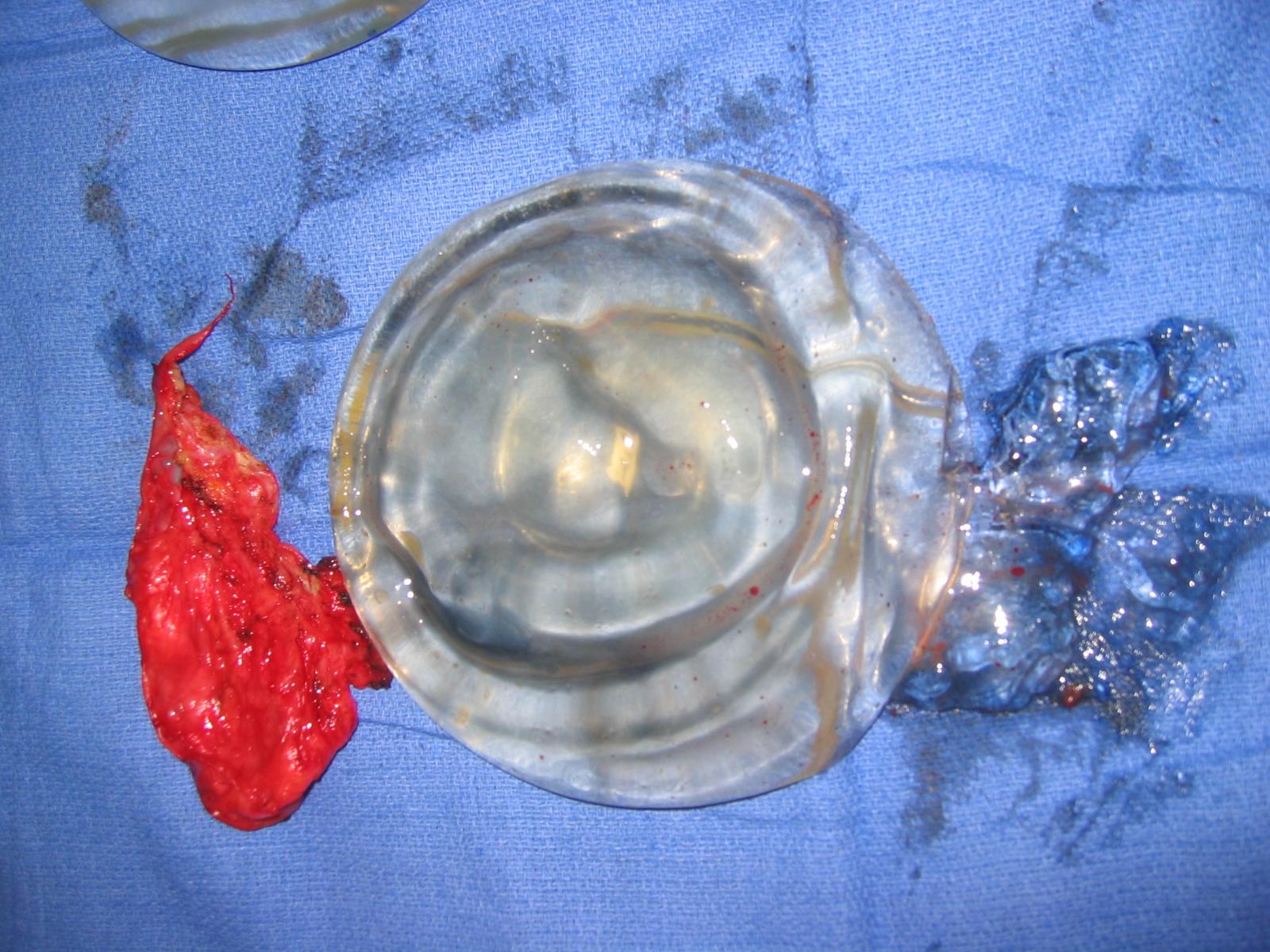 Xylocaine® Jelly
