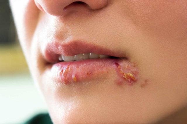Bệnh herpes miệng và sinh dục: Những thông tin cần biết!