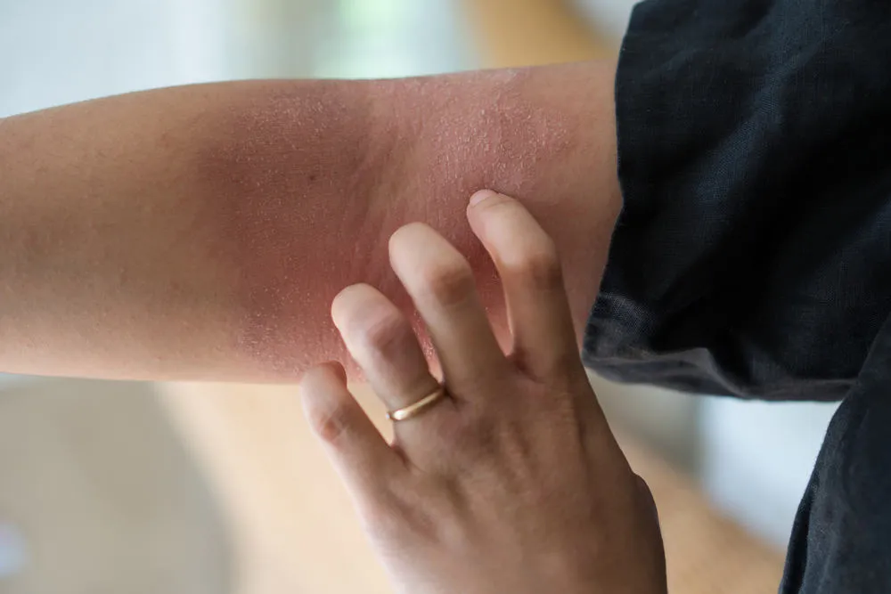 Những dấu hiệu cảnh báo bạn bị viêm da