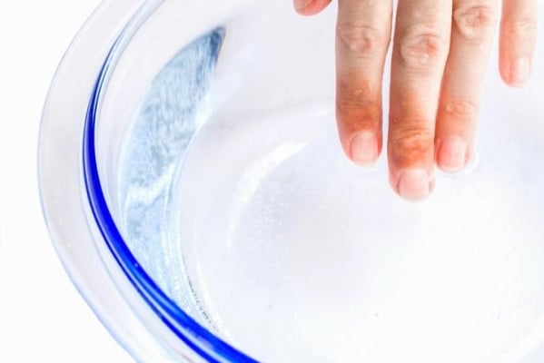 cách sơ cứu khi bị bỏng