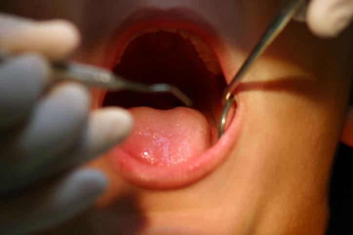 Tổng quát về phương pháp rút tủy răng