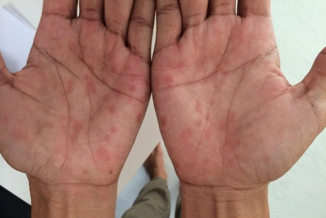 Xuất hiện vết loét trên da không đau: Rất có thể là bệnh giang mai