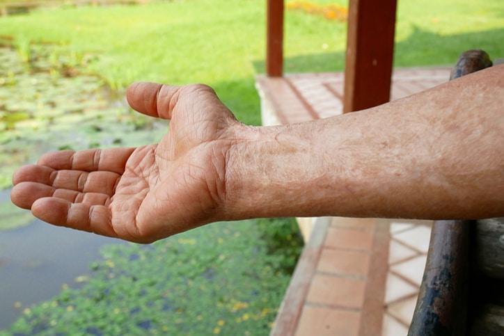 Phân loại các dạng sẹo do bỏng và cách điều trị