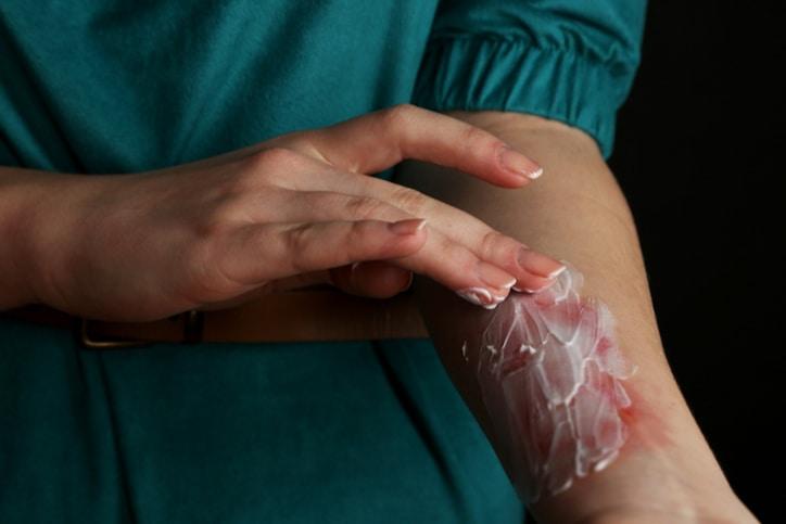 Cách trị bỏng không để lại sẹo hiệu quả ngay tại nhà