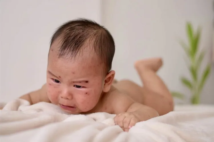 Những điều bố mẹ cần biết về vắc xin thủy đậu