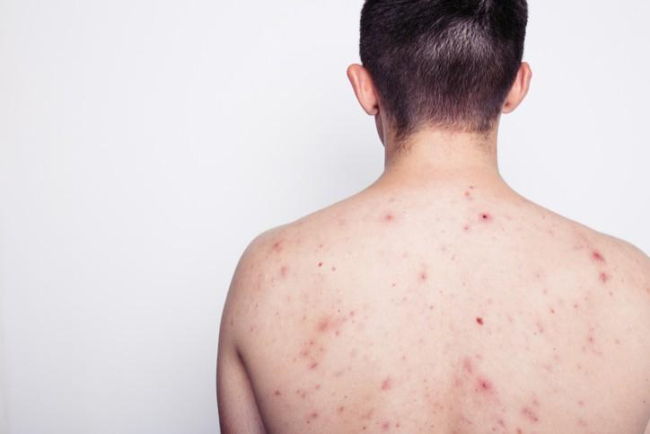 Bệnh HIV và các biến chứng nguy hiểm bạn cần biết