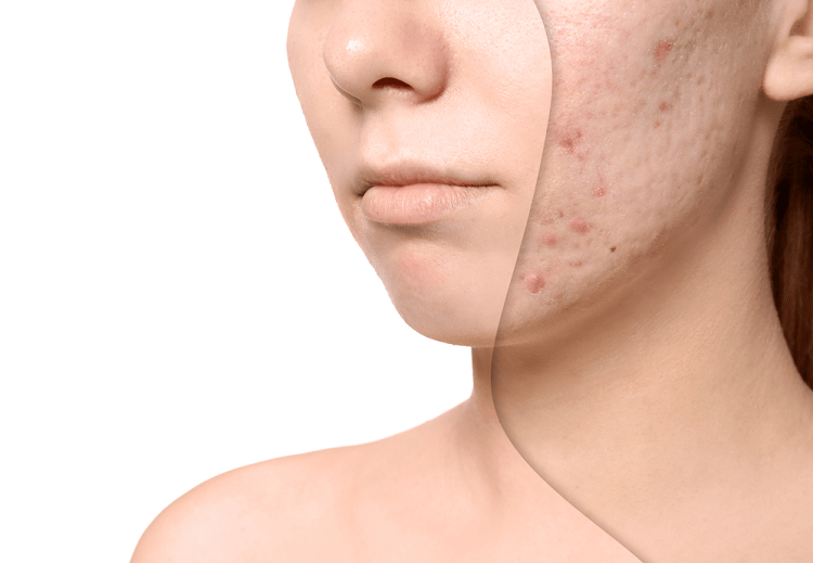 Các phương pháp trị sẹo lõm lâu năm, lấp đầy sẹo hiệu quả