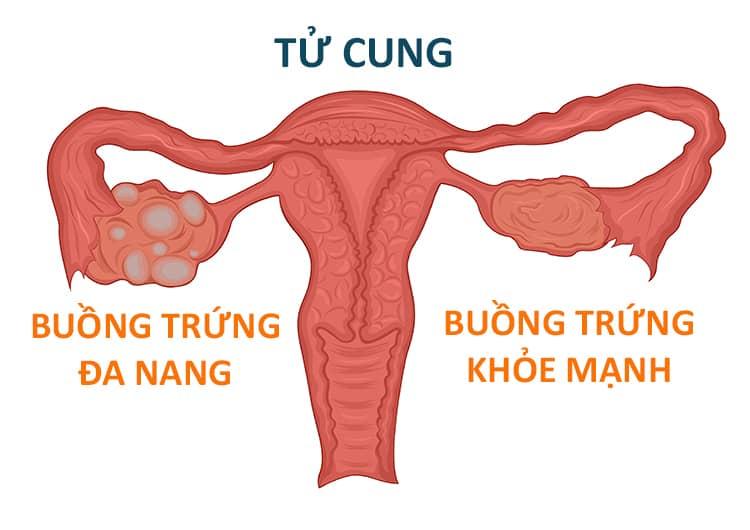 Chuyên gia giải đáp: Bị buồng trứng đa nang làm tăng nguy cơ mắc bệnh gì?