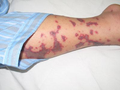 viem-mang-nao-mo-cau