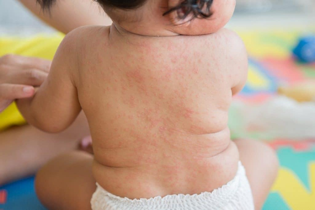 Sốt phát ban ở trẻ nhỏ: Bố mẹ cần làm gì để bé nhanh khỏi?