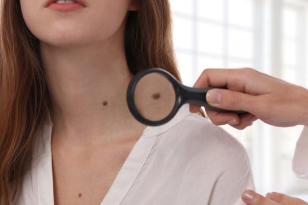 Các cách tẩy nốt ruồi tại nhà (xóa nốt ruồi) an toàn bạn nên cân nhắc: Những điều cần biết Hello Bacsi