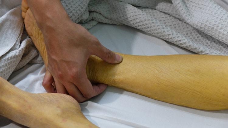 Vàng da tắc mật