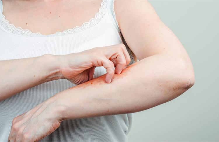 Bọ chét cắn có nguy hiểm không? Cách trị bọ chét cắn đơn giản, hiệu quả