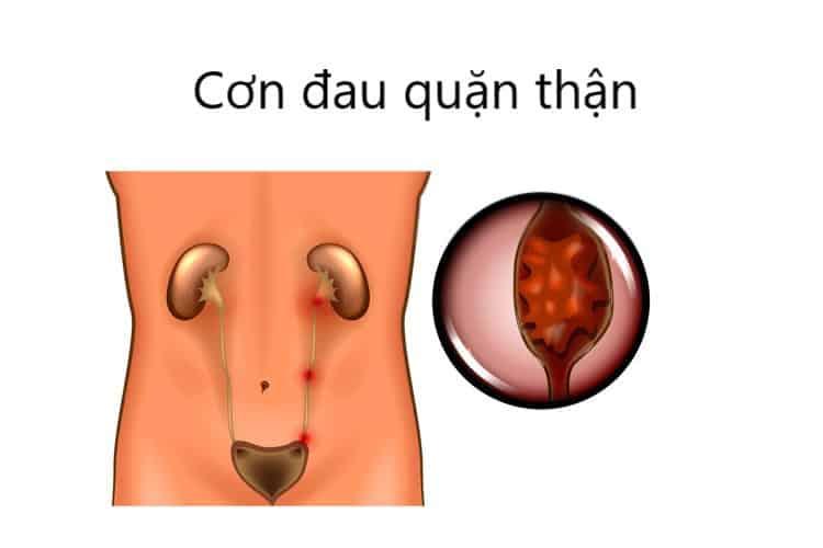 Cơn đau quặn thận