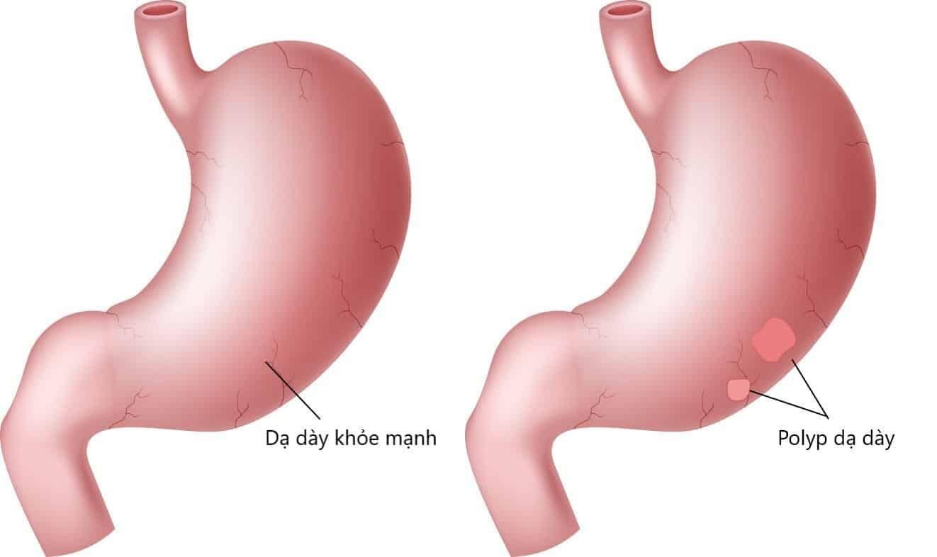 Polyp dạ dày là gì? Nguyên nhân, triệu chứng và cách chữa trị