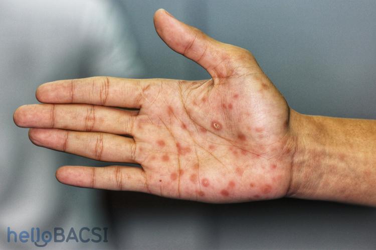 Triệu chứng bệnh giang mai qua từng giai đoạn