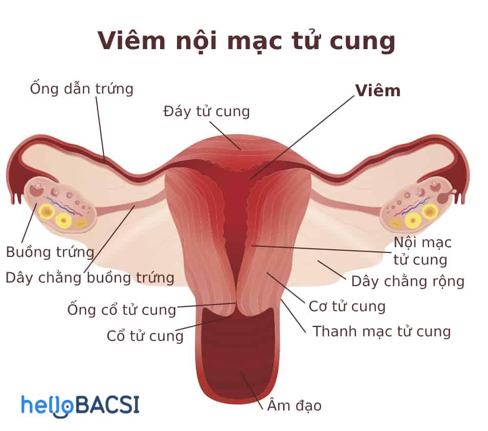 Viêm nội mạc tử cung