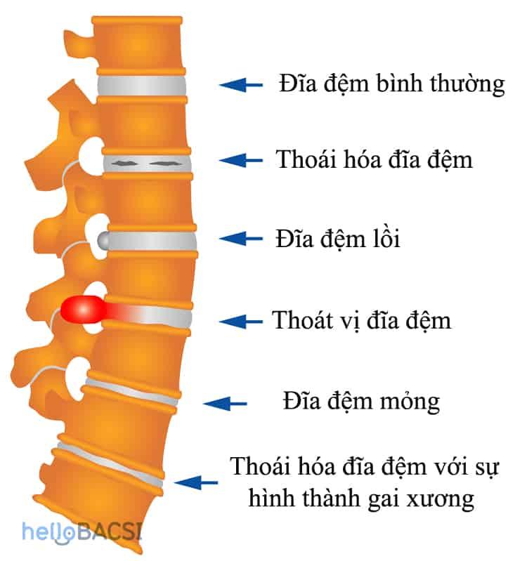 Thoát vị đĩa đệm thường xảy ra ở đốt sống thắt lưng