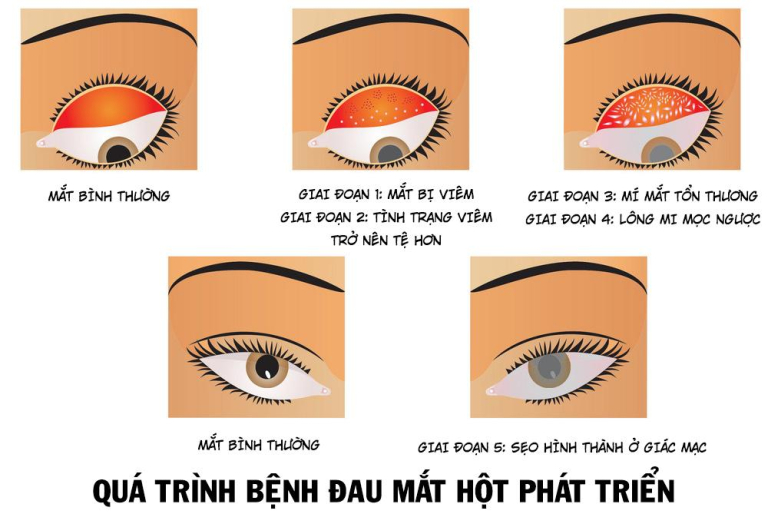 Bệnh đau mắt hột 1