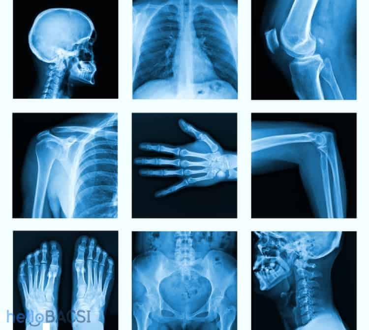 Quy trình chụp X-quang là gì? Chụp X quang bao lâu có kết quả?