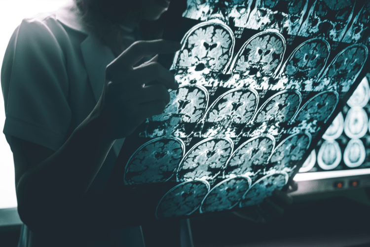 các loại bệnh alzheimer